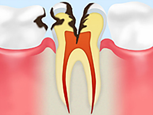 神経の虫歯（C3）